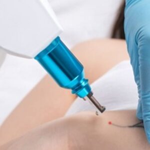 Modul: BKF (Erweitert) EFZ, FA und HFP - Tattoo Entfernung